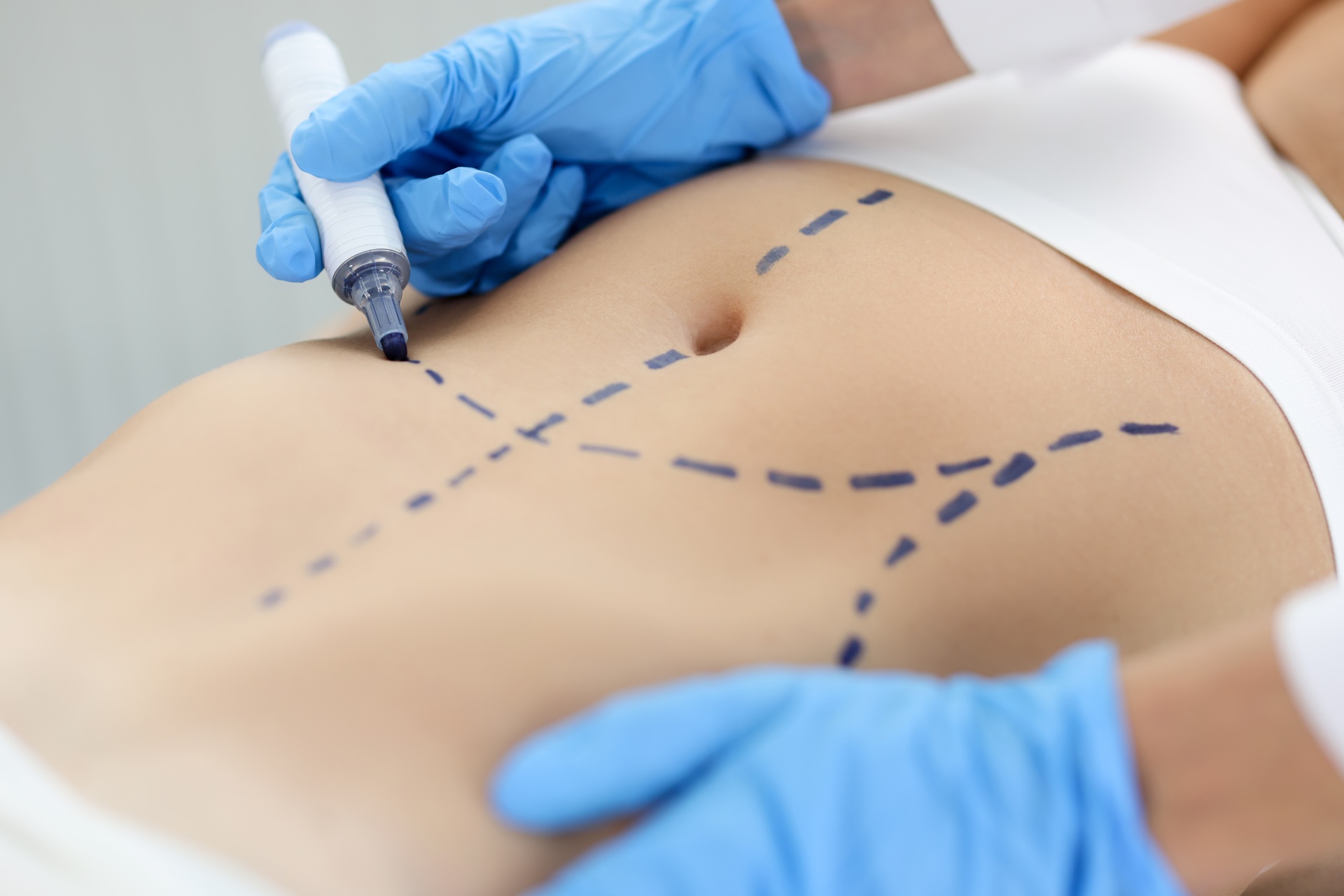 Abdominoplastyka