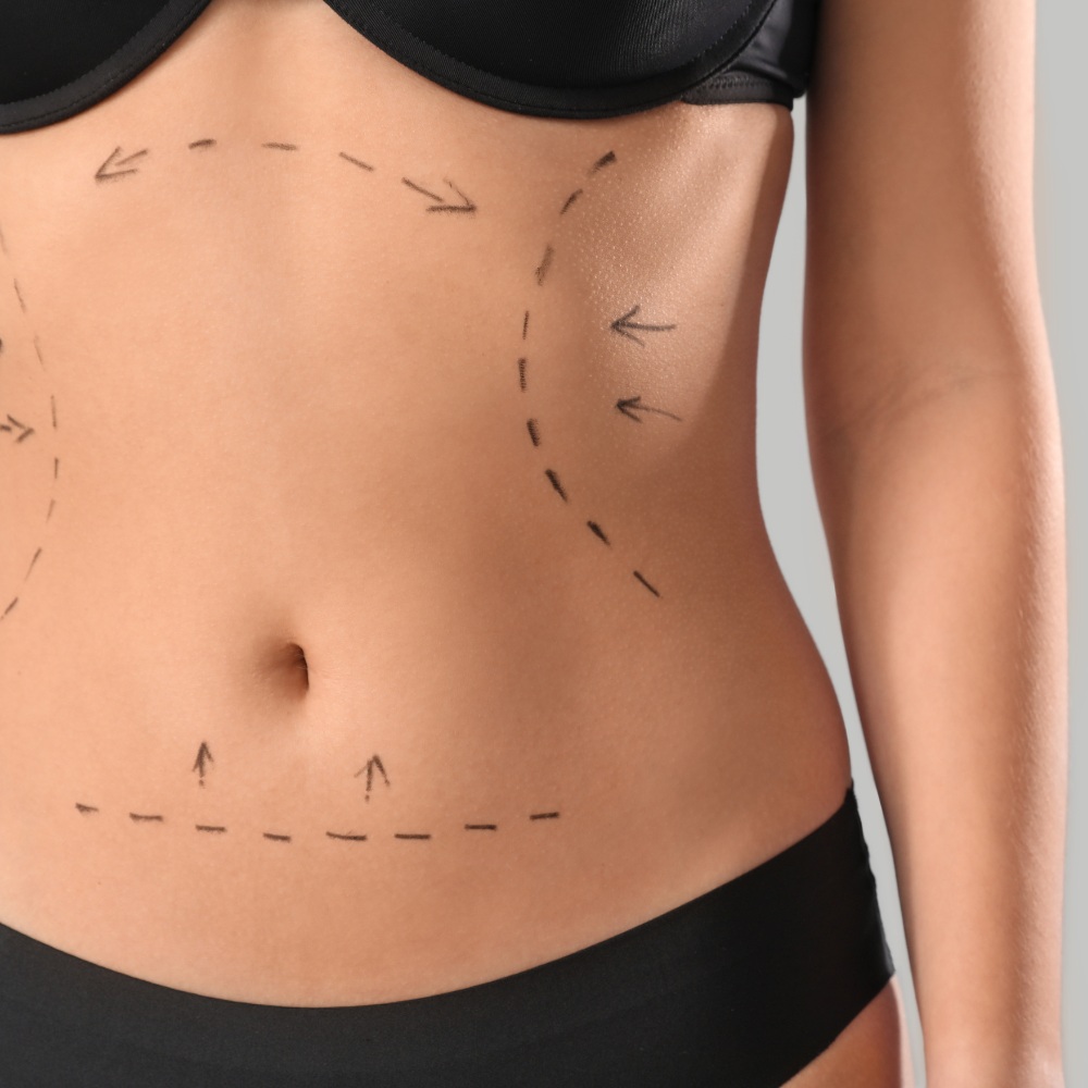 Abdominoplastyka Łódź efekty zabiegu
