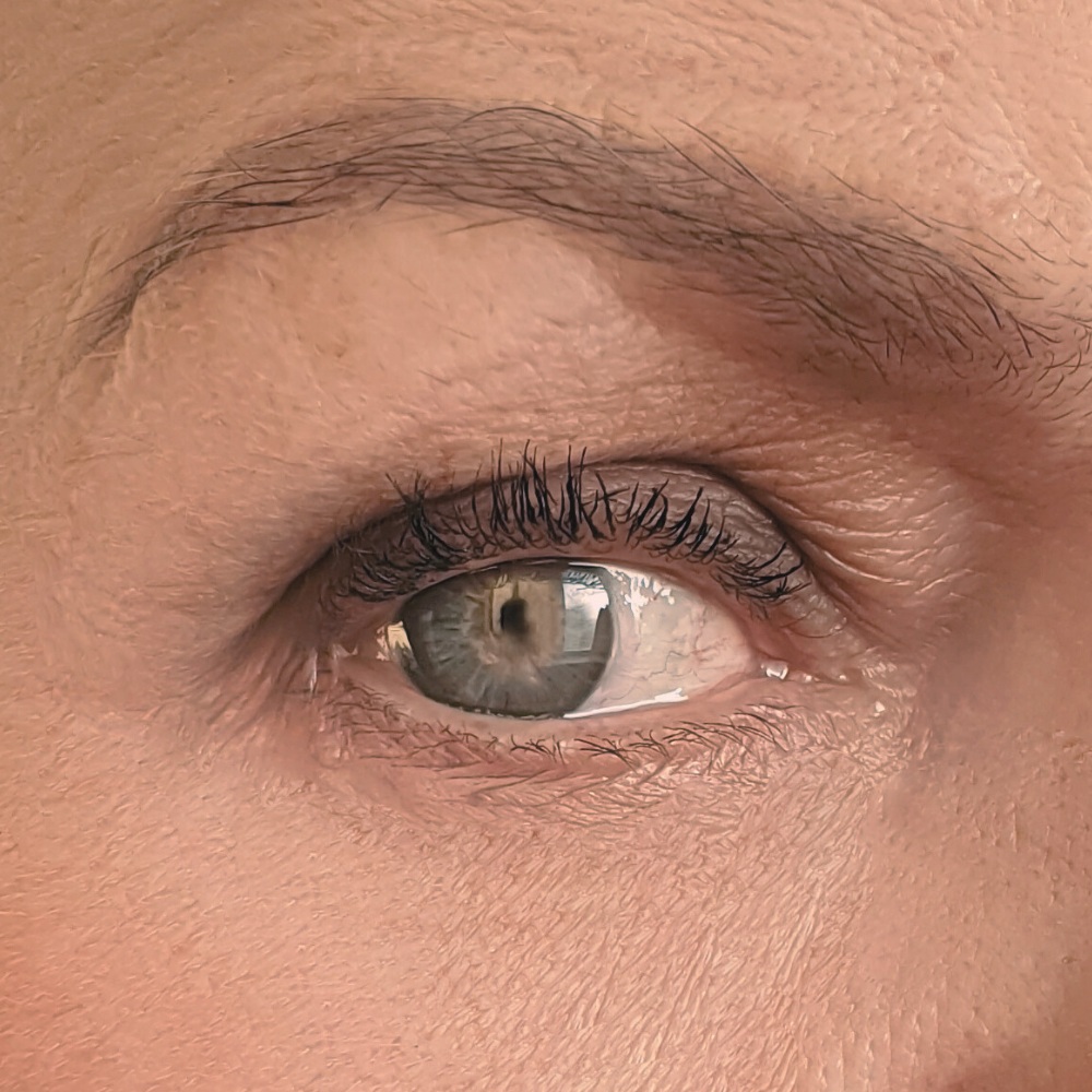 Brow lift - lifting brwi Łódź - efekty zabiegu