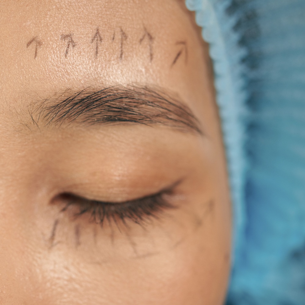 Brow lift - lifting brwi Łódź - zabieg