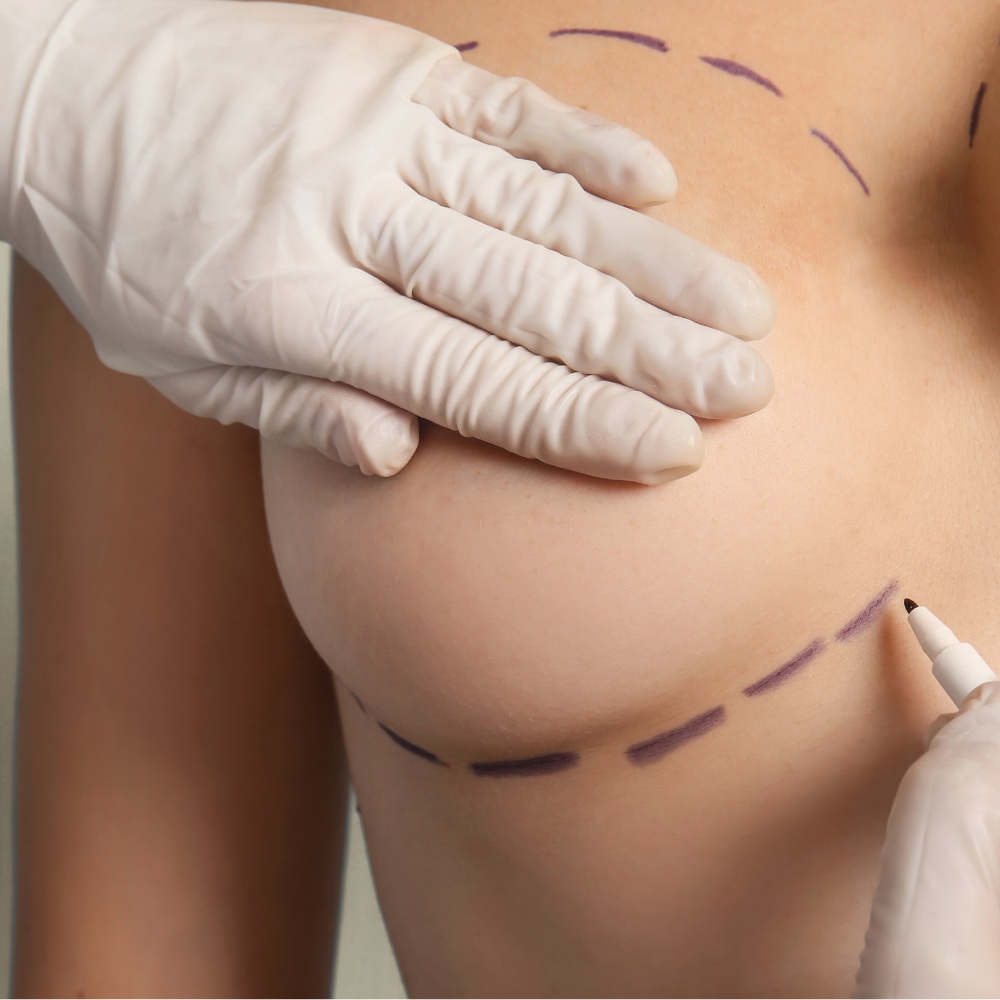 Lipotransfer Łódź - efekty