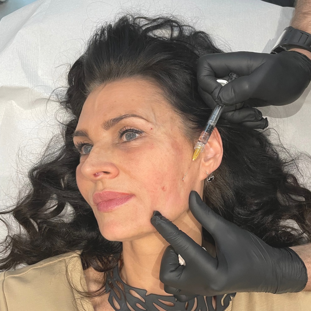 Efekty Wolumetria twarzy Łódź - SILVER Clinic