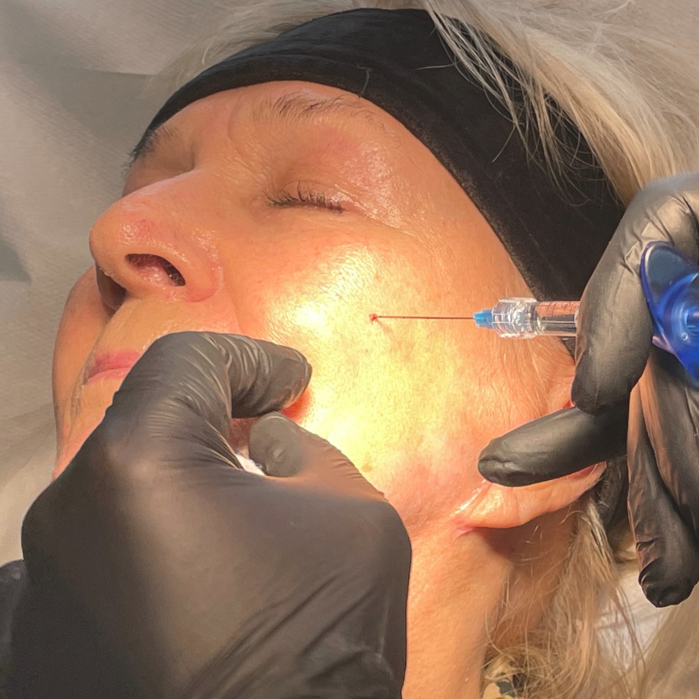 Efekty Wypełnianie zmarszczek Łódź - SILVER Clinic