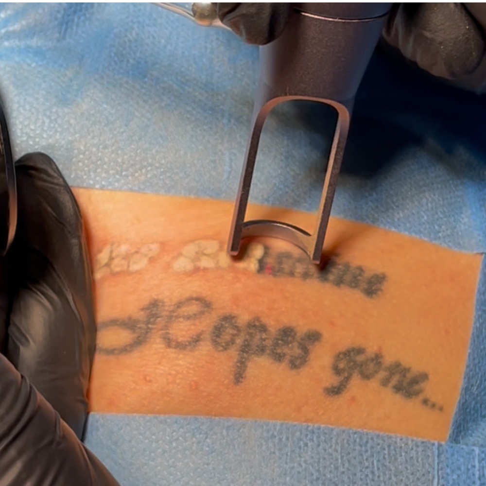 Efekt Laser pikosekundowy Łódź - SILVER Clinic