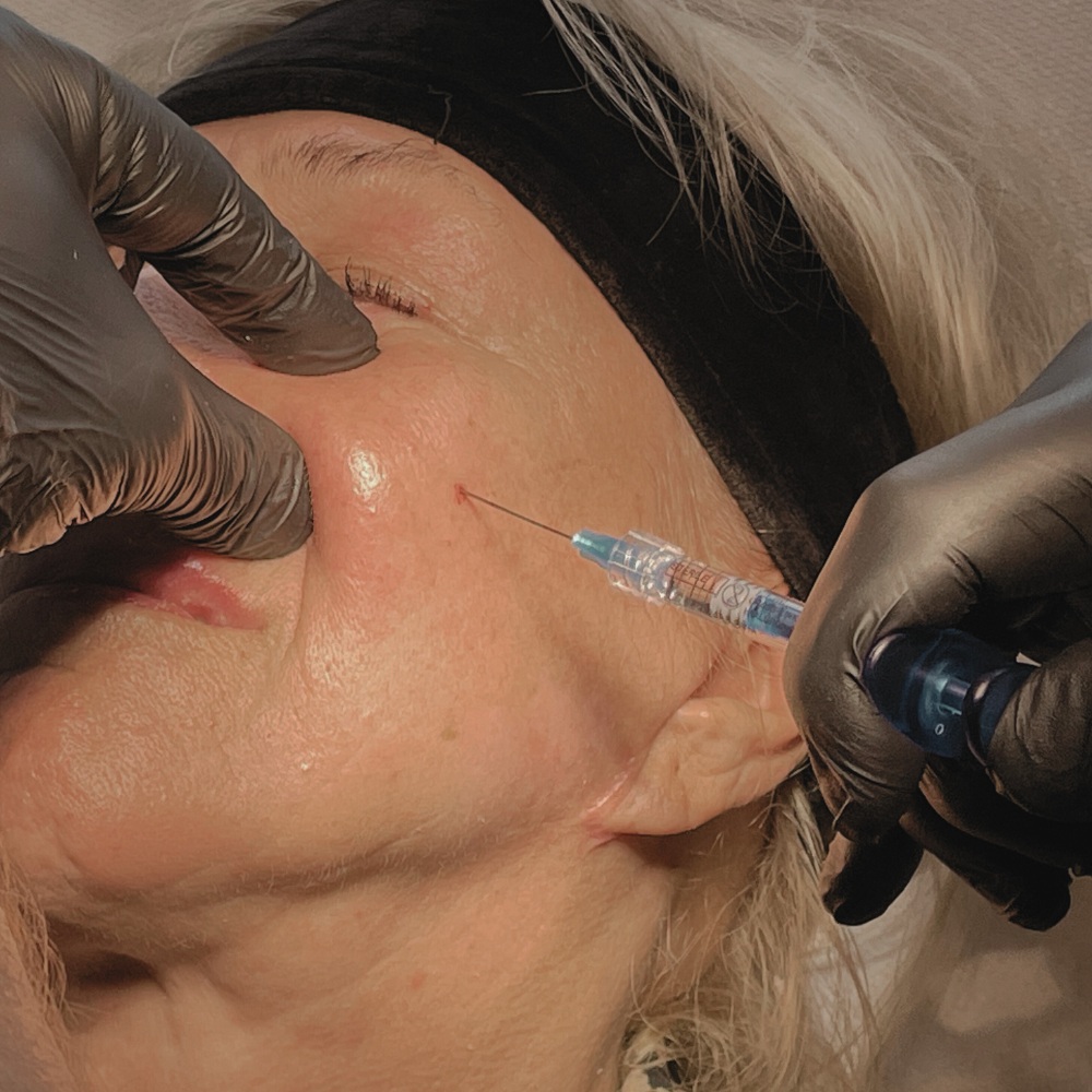 Efekty Lifting 7 i 9 punktowy Łódź - SILVER Clinic