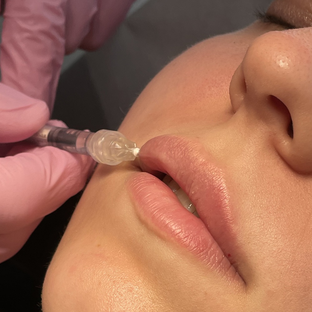 Zabieg Powiększanie ust Łódź - SILVER Clinic