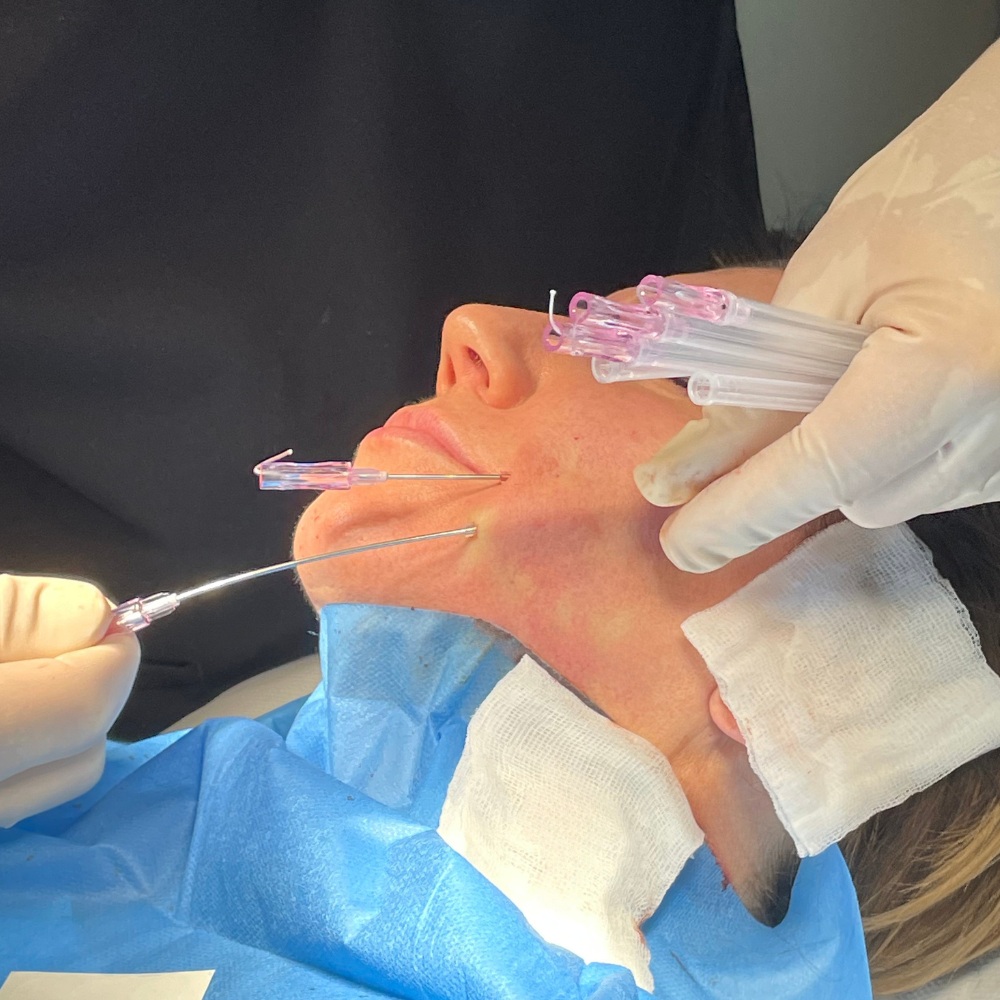 Nici liftingujące PCL Łódź Efekty - SILVER Clinic
